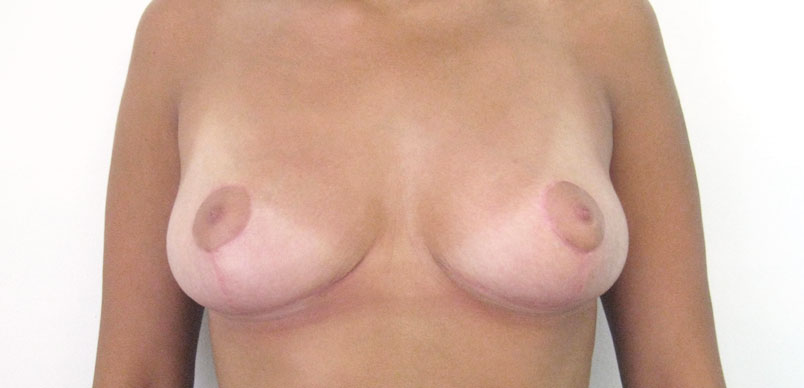 After breast asymmetry surgery photograph